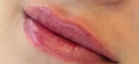 Lábios depois do preenchimento, com volume e contorno naturais