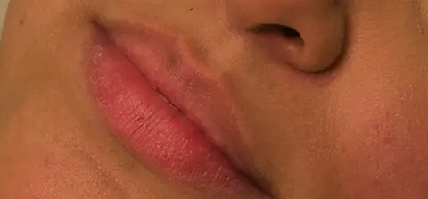 Antes: lábios com pouco volume
