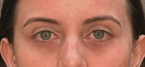 Antes: olhar com aparência cansada e olheiras marcadas
