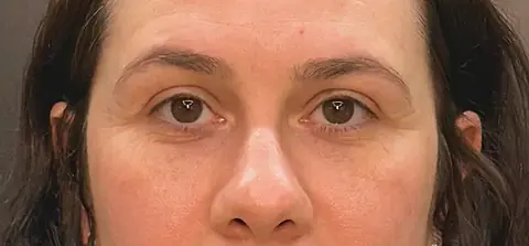 Antes: olheiras fundas e malar sem sustentação