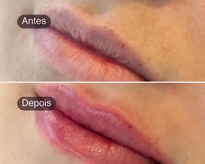 Lábios antes e depois do preenchimento, com mais volume e contorno