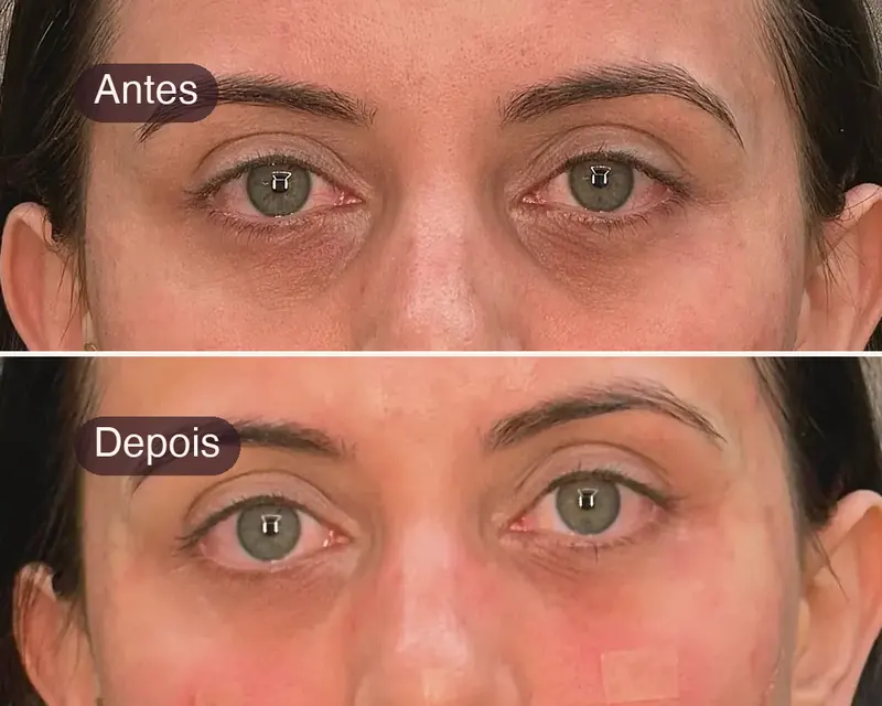 Olhar antes e depois do tratamento, com aparência mais descansada
