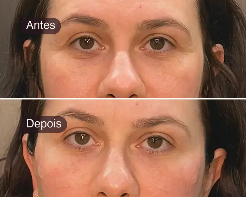 Rosto antes e depois do preenchimento de olheiras e malar